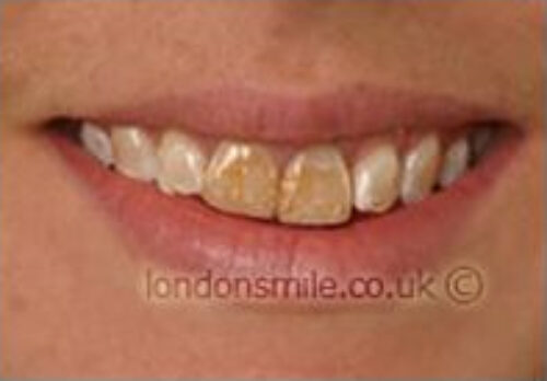 Before Image - The London Smile Clinic