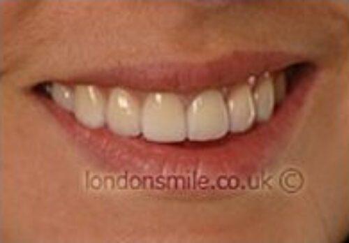 After Image - The London Smile Clinic