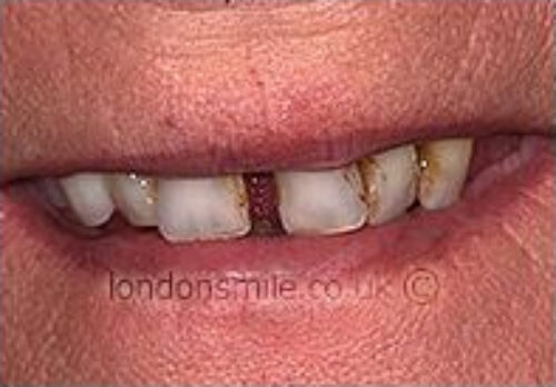 Before Image - The London Smile Clinic