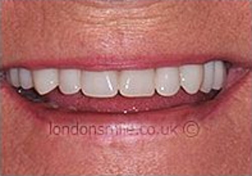 After Image - The London Smile Clinic