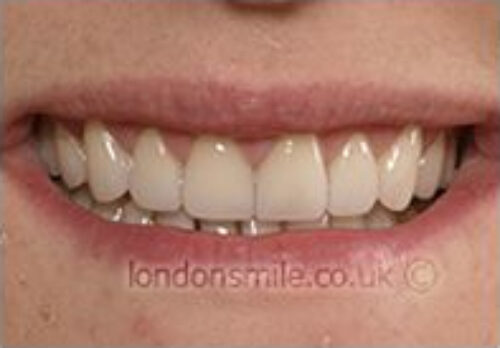 After Image - The London Smile Clinic