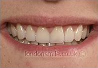 After Image - The London Smile Clinic