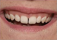 Before Image - The London Smile Clinic