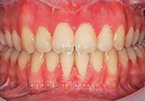 Case-2-10-a After Image - The London Smile Clinic