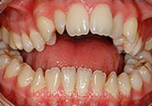 Case-2-10-b Before Image - The London Smile Clinic