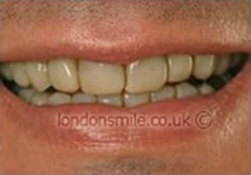 Before Image - The London Smile Clinic