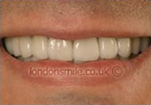 After Image - The London Smile Clinic