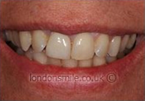 Before Image - The London Smile Clinic