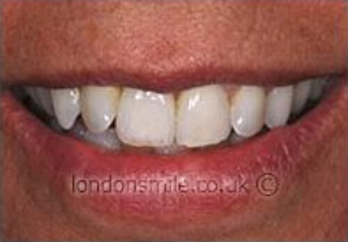 After Image - The London Smile Clinic