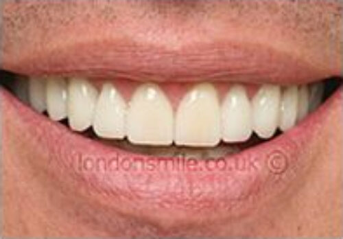 After Image - The London Smile Clinic