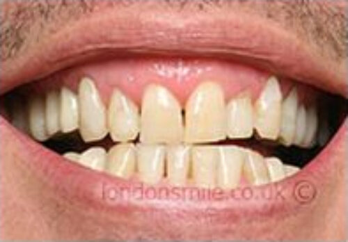 Before Image - The London Smile Clinic