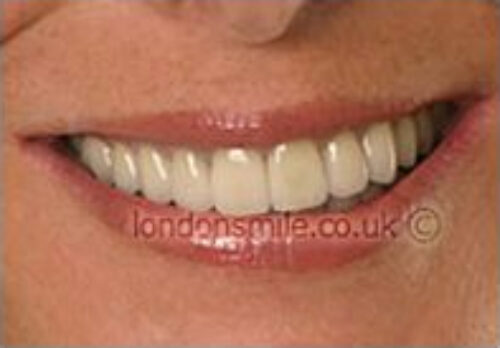 Case-2-8-a After Image - The London Smile Clinic
