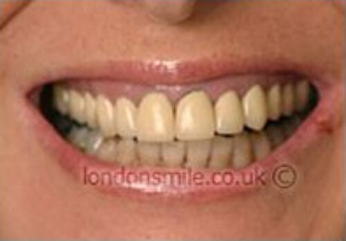 Case-2-8-b Before Image - The London Smile Clinic
