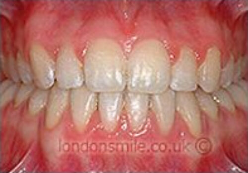 Case-3-10-a After Image - The London Smile Clinic