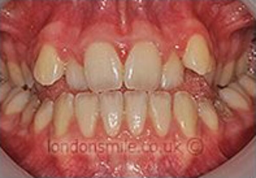 Case-3-10-b Before Image - The London Smile Clinic