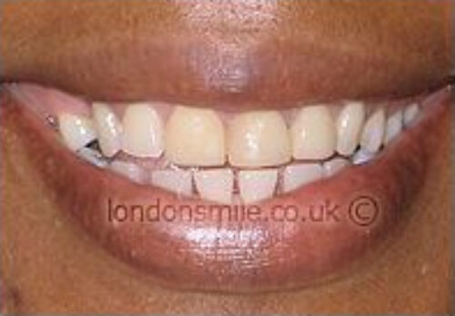 Before Image - The London Smile Clinic