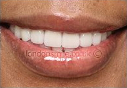 After Image - The London Smile Clinic