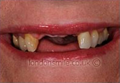 Before Image - The London Smile Clinic
