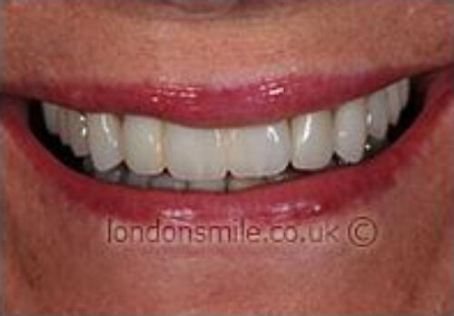 After Image - The London Smile Clinic