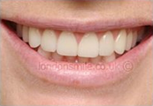 After Image - The London Smile Clinic