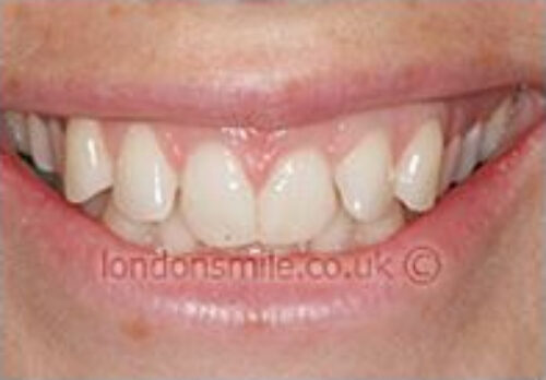 Before Image - The London Smile Clinic