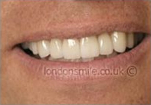 Case-3-8-a After Image - The London Smile Clinic