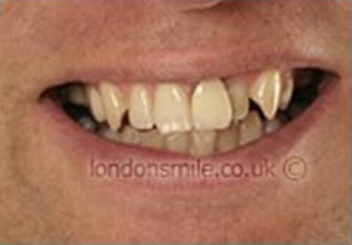 Case-3-8-b Before Image - The London Smile Clinic