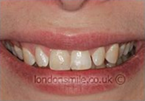 Before Image - The London Smile Clinic