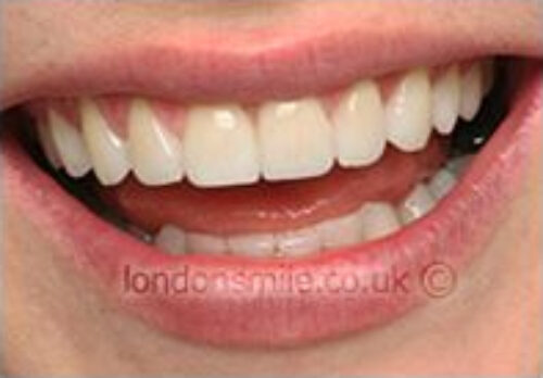 After Image - The London Smile Clinic