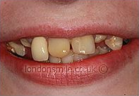 Before Image - The London Smile Clinic