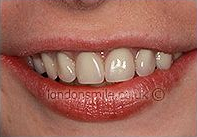 After Image - The London Smile Clinic