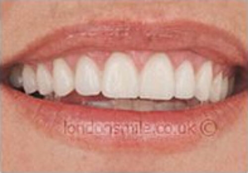 After Image - The London Smile Clinic