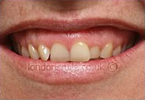 Before Image - The London Smile Clinic