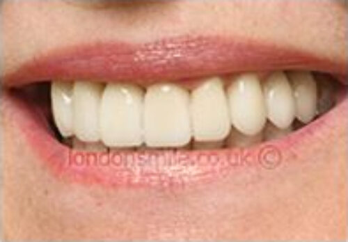 Case-4-8-a After Image - The London Smile Clinic