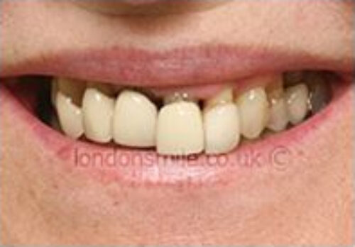 Case-4-8-b Before Image - The London Smile Clinic