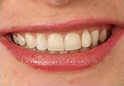 After Image - The London Smile Clinic