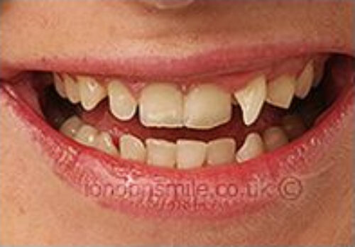 Before Image - The London Smile Clinic