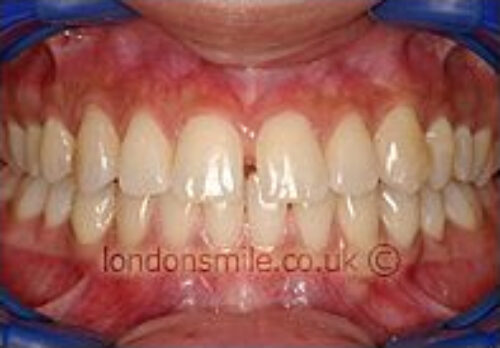 Before Image - The London Smile Clinic
