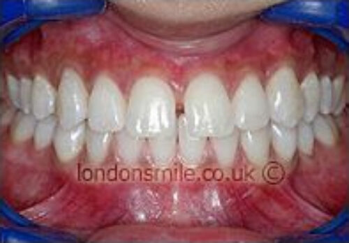 After Image - The London Smile Clinic