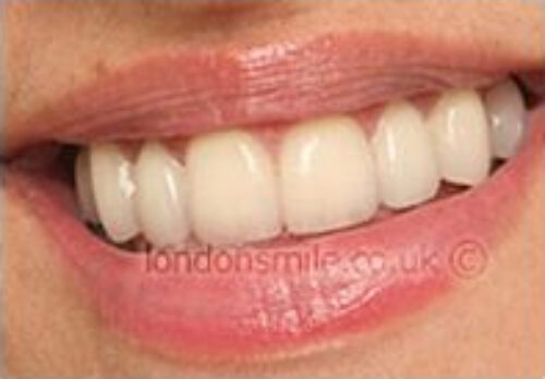 After Image - The London Smile Clinic