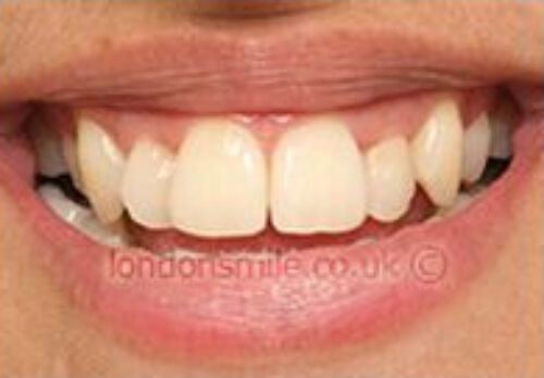 Before Image - The London Smile Clinic