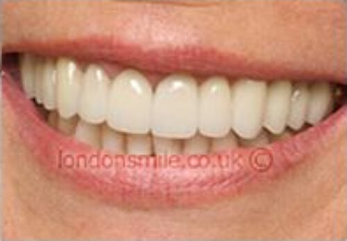 Case-5-6-a After Image - The London Smile Clinic