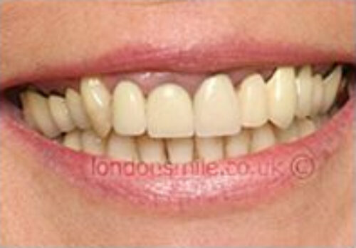 Case-5-6-b Before Image - The London Smile Clinic