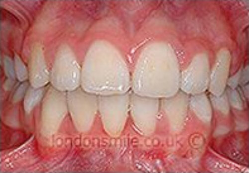 After Image - The London Smile Clinic