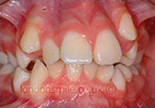 Before Image - The London Smile Clinic