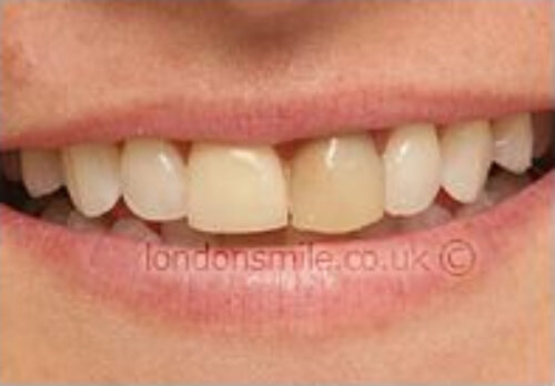 Before Image - The London Smile Clinic
