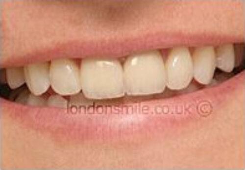 After Image - The London Smile Clinic