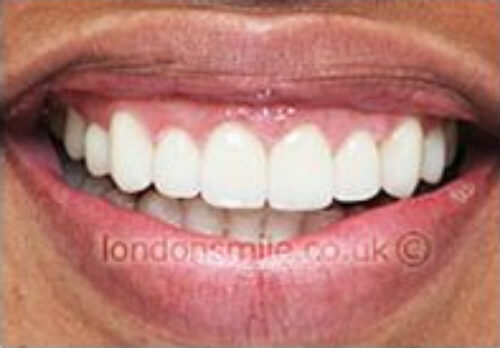 After Image - The London Smile Clinic
