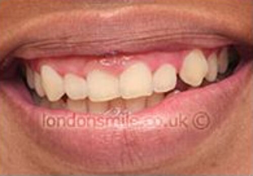 Before Image - The London Smile Clinic