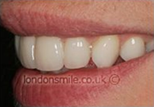 Case-6-6-a After Image - The London Smile Clinic